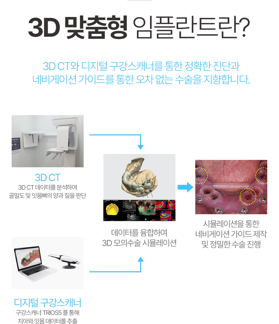 3D 맞춤형 임플란트란?