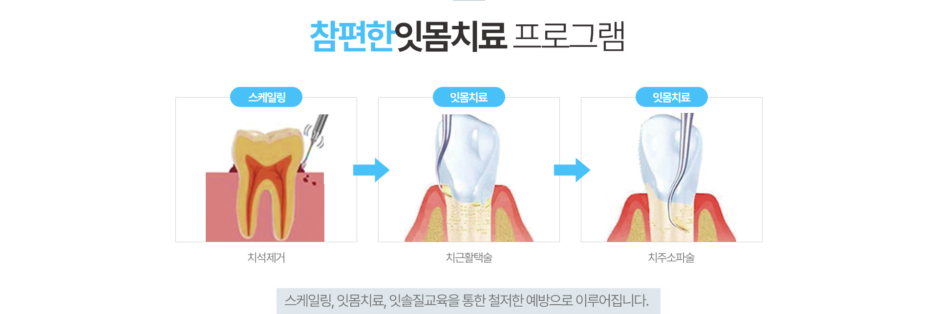 참현한 잇몸치료 프로그램